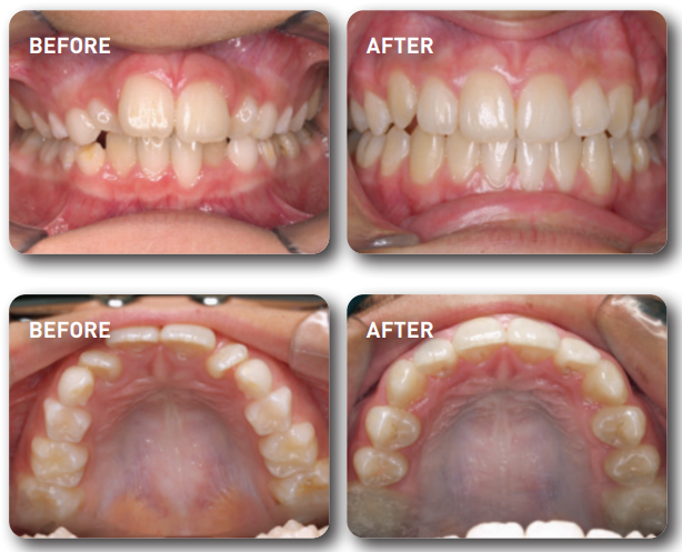teeth before and after myobrace 
