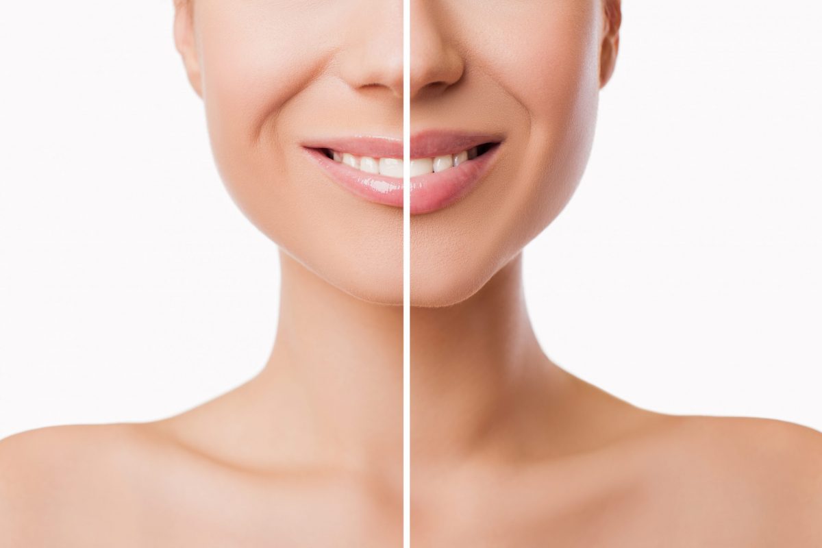 lip filler treatment at Midas Dental results in plumper lips