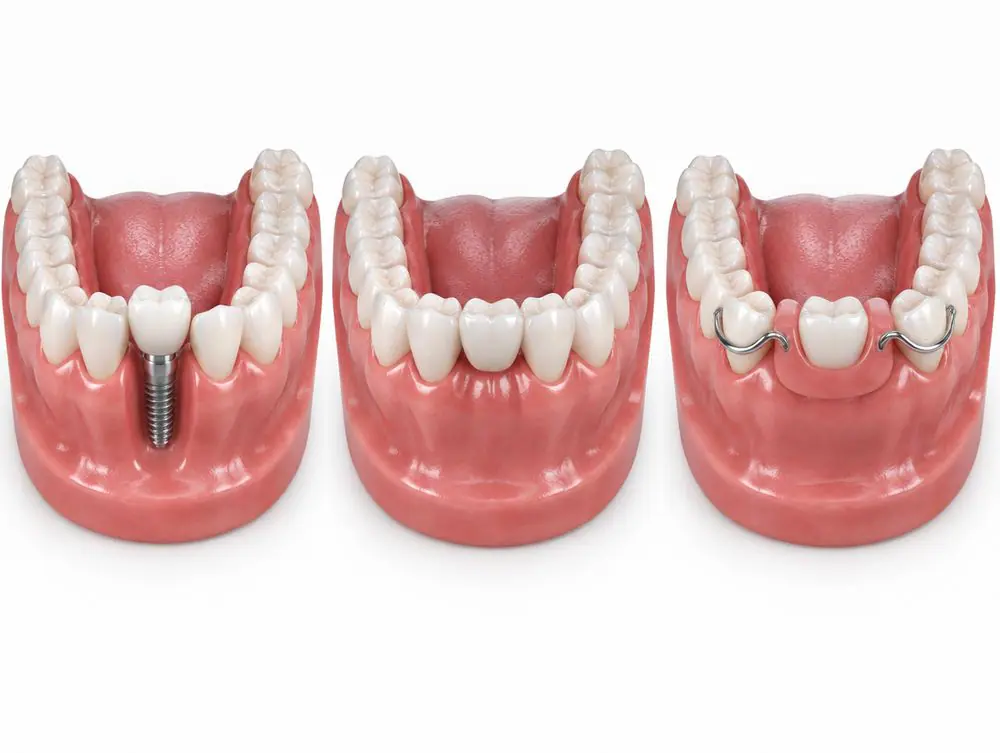 Three ways to replace one missing tooth: a dental implant, a dental bridge and a removable partial denture, shown on jaw models